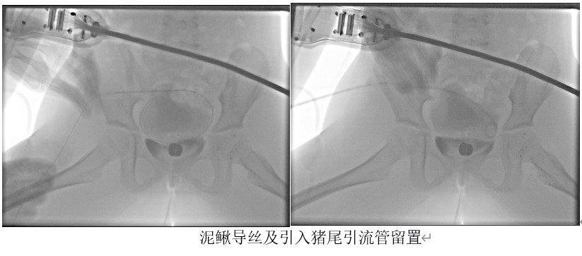 儿童腹腔淋巴管瘤介入微创治疗病例