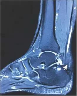 男子脚上有一个大包,小伙脚上长了个大脓包