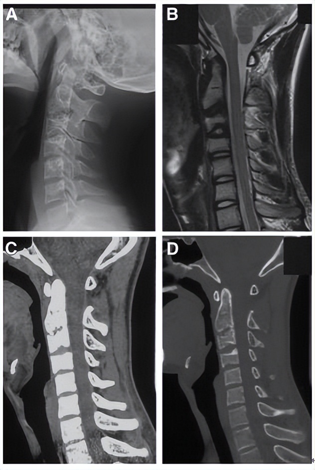 颈椎常见病变图片,颈椎严重的病例