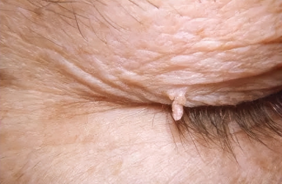 女性hpv高危型病毒16能自愈吗,女性一生中感染hpv的几率达80%