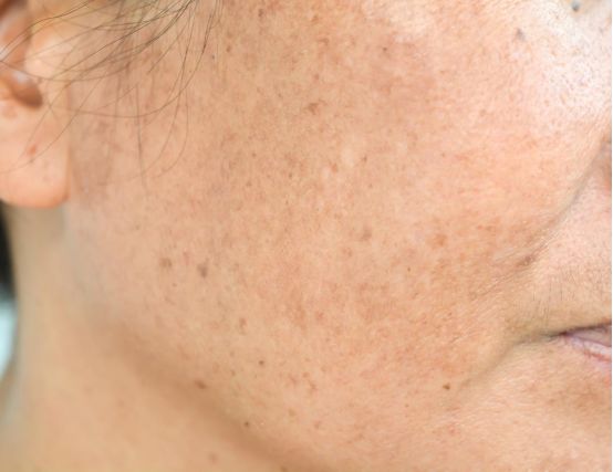 为什么40岁的女人整个脸都是斑,女人到40脸上就开始长斑怎么解决