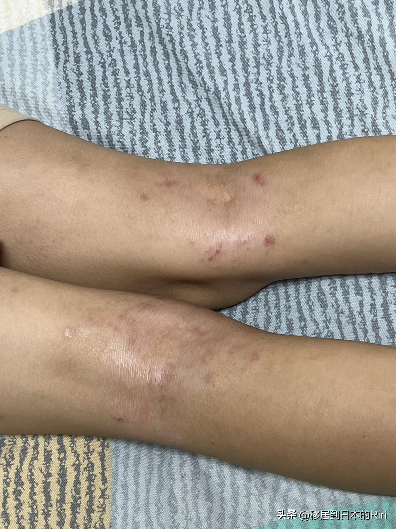 日本神经性皮炎,日本过敏性皮炎