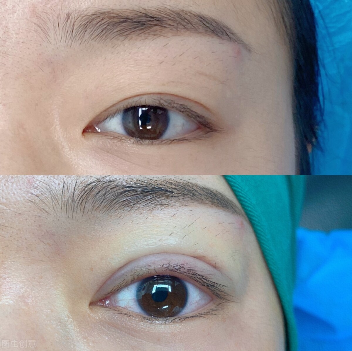 割双眼皮后失败怎么补救,双眼皮手术失败多久才能二次修复