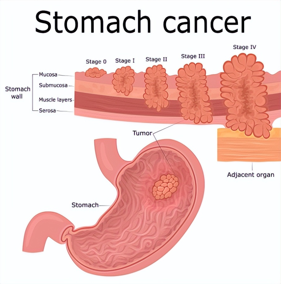 胃病怎么得来的粤语,胃病是怎么来的中医解答