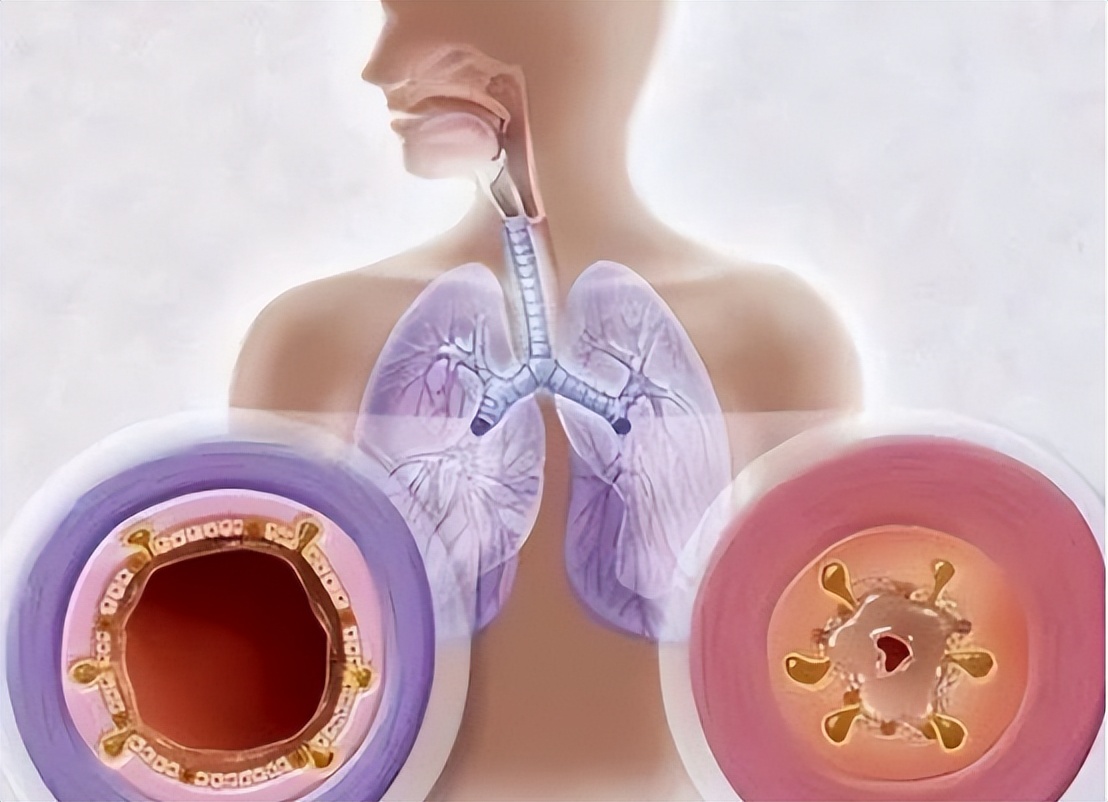 胸腔镜下胸膜冷冻活检，在胸腔积液诊断中，有价值和安全性么