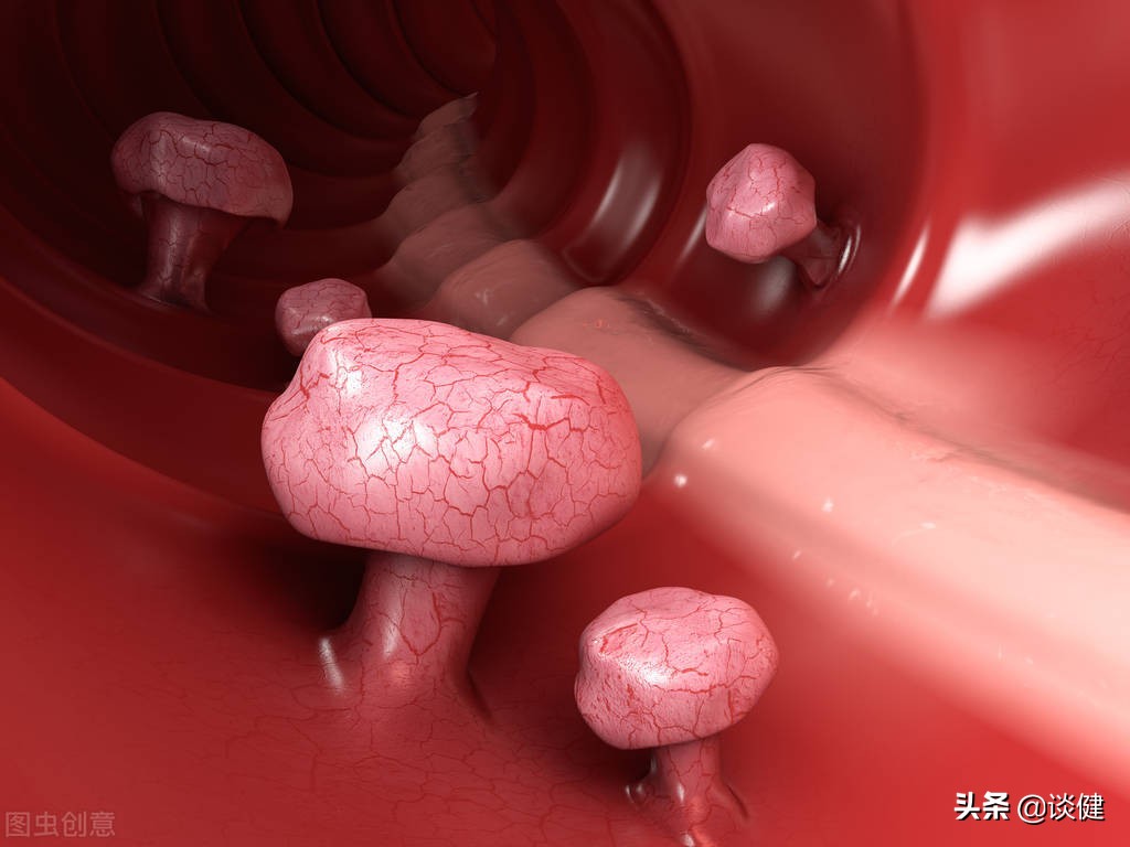 大肠息肉会变成癌吗,大肠息肉切除后还会癌变吗