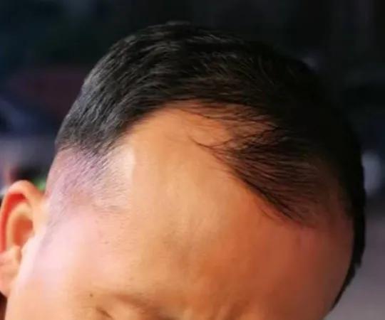 雄脱植发的亲身经历和感受,16000字讲述植发真实感受