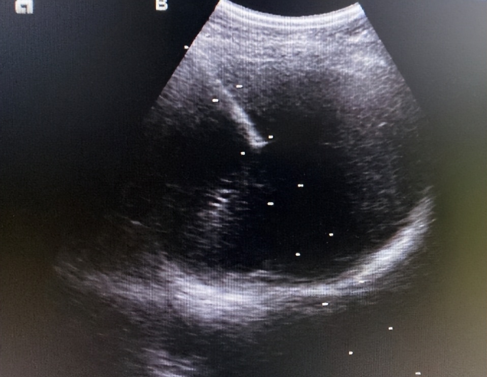 介入穿刺全过程,介入穿刺技术