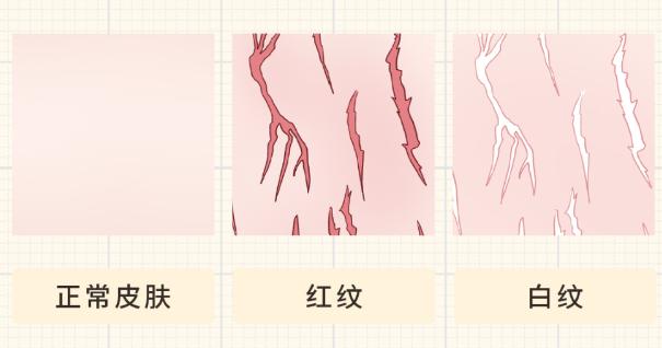 女生大腿有白色条纹是怎么回事,大腿和臀部有白色条纹怎么解决