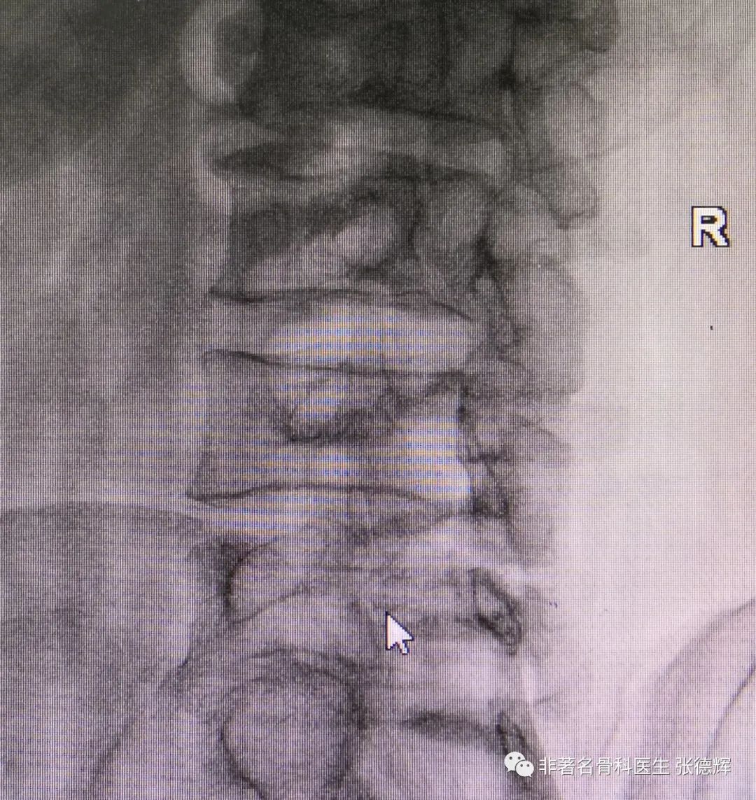 腰椎峡部裂的最好治疗方法,腰椎峡部裂
