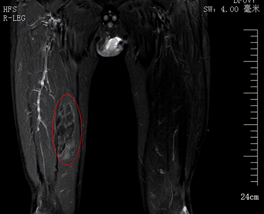 身体上长了个包,身体上长了硬硬的包怎么回事