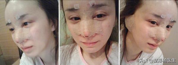 隆鼻最安全的是哪种隆鼻方法啊,先来了解一波隆鼻科普