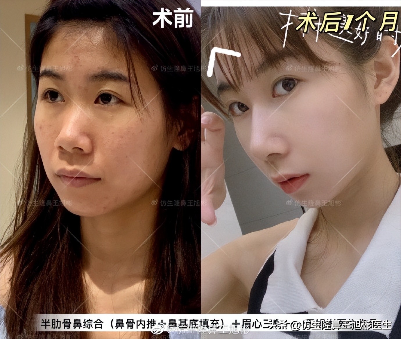 隆鼻鼻型科普,鼻基底凹陷隆鼻可以改善吗