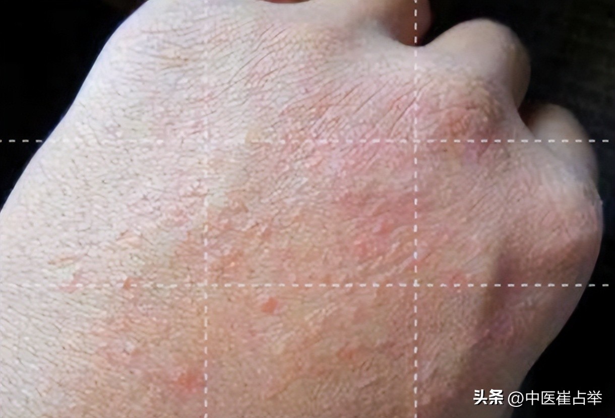 膀胱湿热祛湿利尿中成药,十大祛湿热的中成药