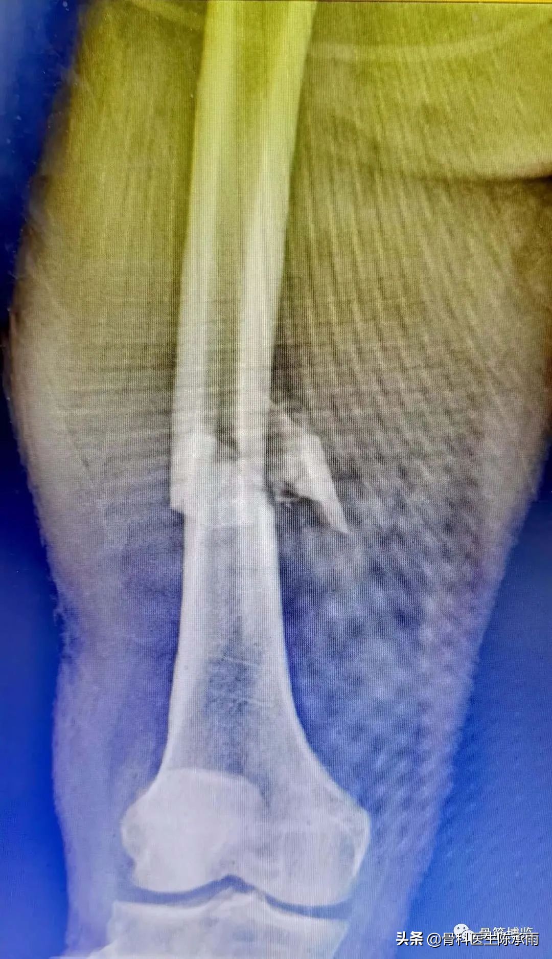 陈旧性腿骨骨折,陈旧性骨折