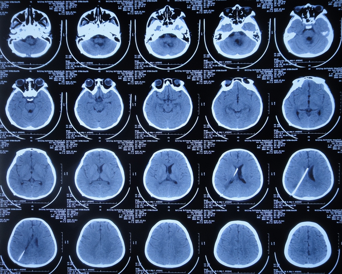 脑干出血儿童,儿童脑干胶质瘤呕吐