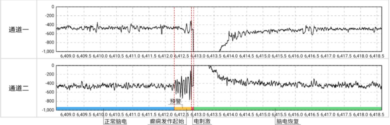 脑内植入ai芯片,脑中植入芯片治疗抑郁症