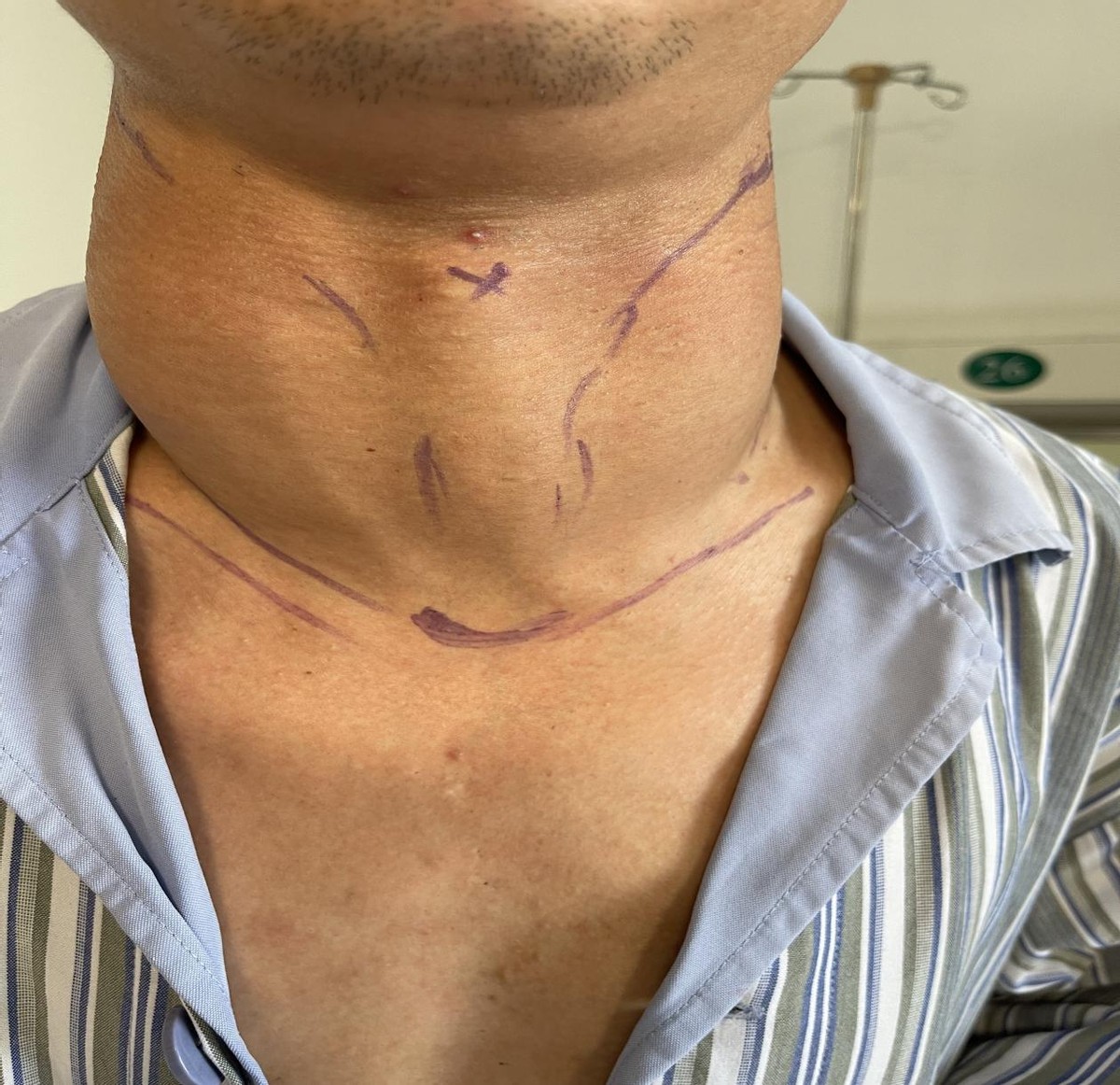 李连杰得甲亢后的照片,李连杰得甲亢前后照片对比