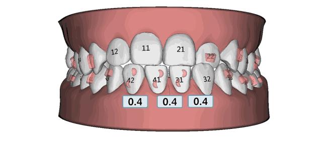 医生牙齿松动,医生说牙齿矫正后会晃动