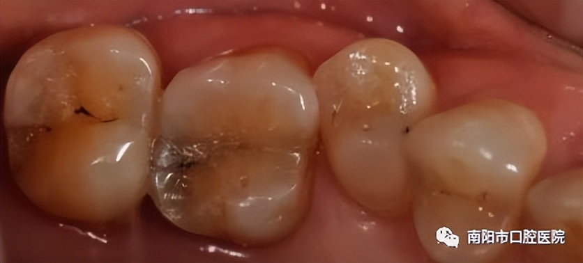 医生问你牙怎么这么不好,医生说我的牙齿裂开了怎么治疗