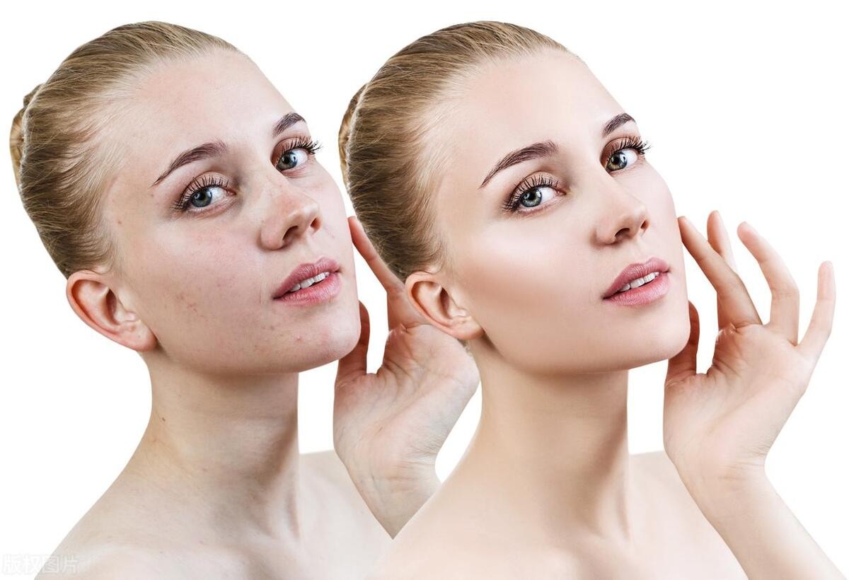 吃异维a酸手背红疹需要停药吗,异维a酸软胶囊吃后手背起红斑