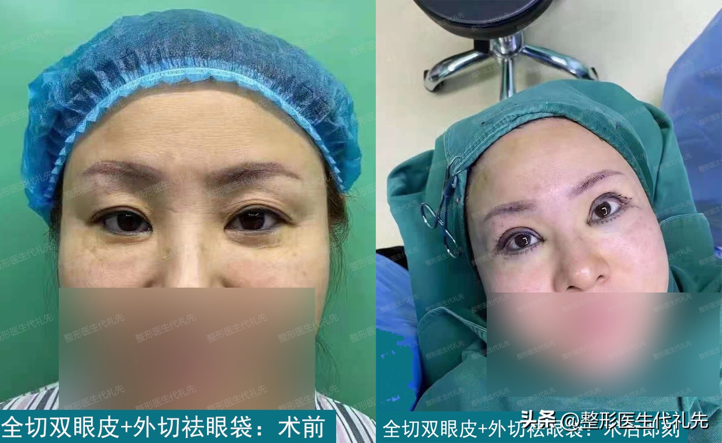 35岁双眼皮切眼袋亲身经历,双眼皮去眼袋全切二个月恢复过程
