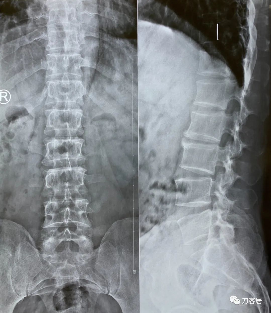 怎样治疗骨质疏松引起的腰椎骨折,骨质疏松性压缩骨折