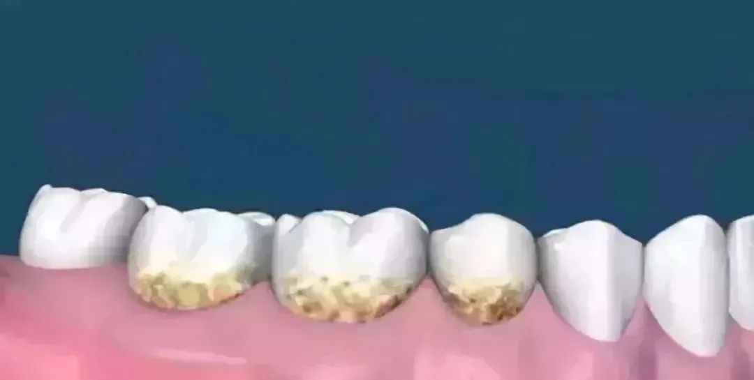 电动冲牙器便携式深层清洁牙齿,牙刷电动软毛护牙