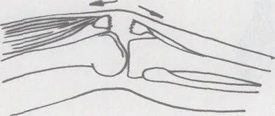 髌骨骨折的临床症状有哪些,髌骨骨折病因及发病机制