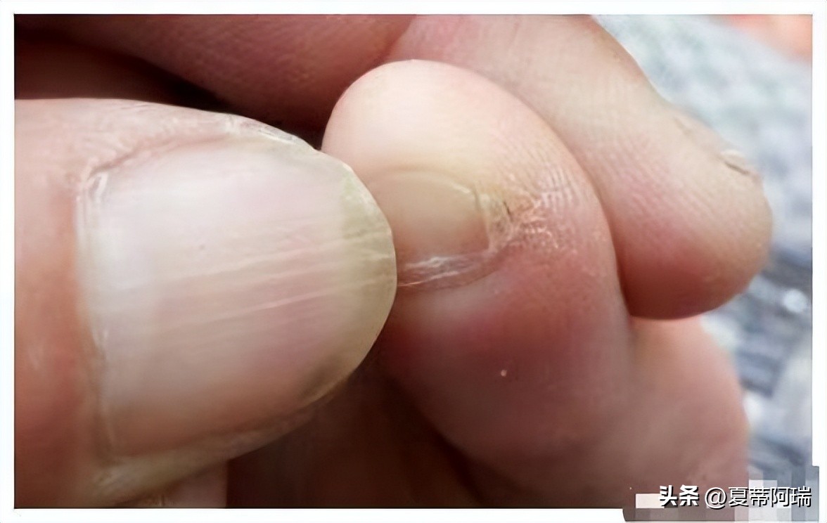 小脚趾甲分叉是汉人还是鲜卑人,为啥小脚趾指甲盖两瓣的是汉人
