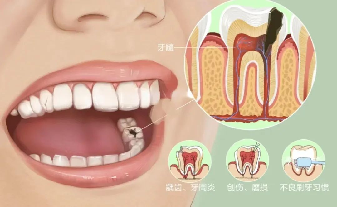 乳牙被蛀了可以补牙吗,乳牙被虫蛀掉了恒牙不出咋办