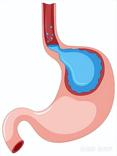 一院消化内科,胃食管反流病国内哪家医院最权威