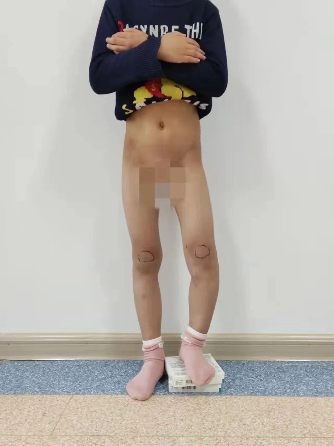 小儿骨科足内翻手术,双足内翻畸形手术