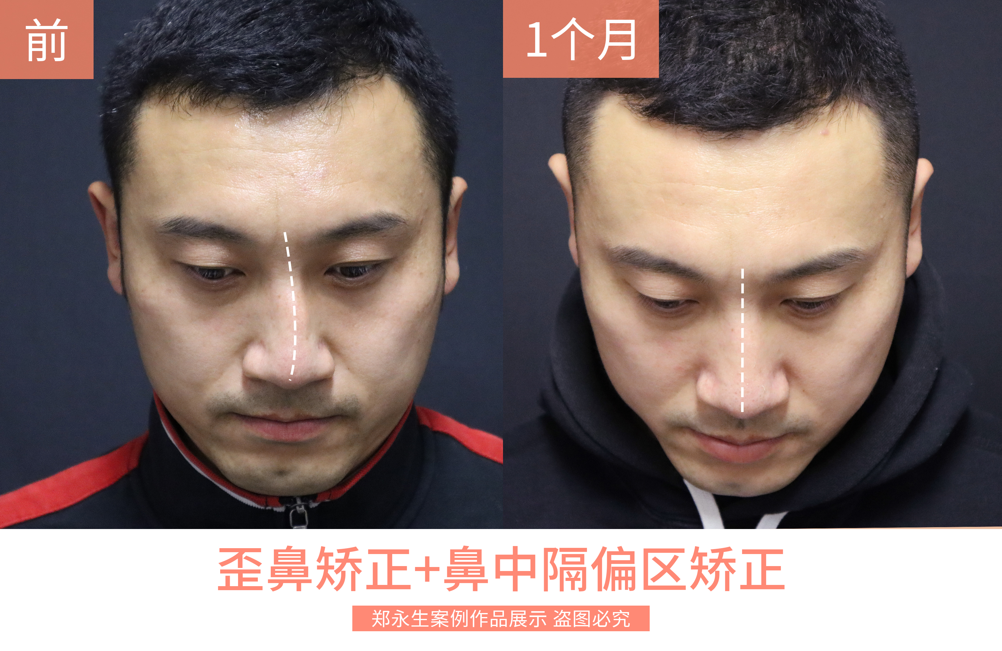 北京八大处整形医院歪鼻矫正,北京同仁医院鼻科知名专家排名