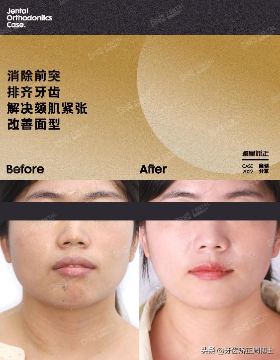 闭嘴巴下巴有核桃纹做什么手术,为什么下巴会有像核桃一样的纹路