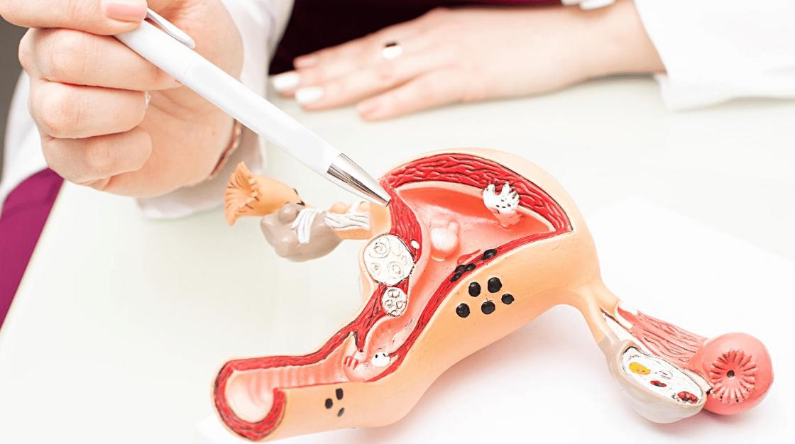 45岁女子确诊宫颈癌,子宫全切,提醒:月经若有这种感觉,别大意