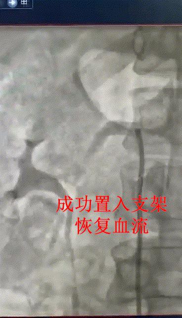 肾动脉狭窄患者介入治疗有危险吗,攻克高血压心脏病最新疗法