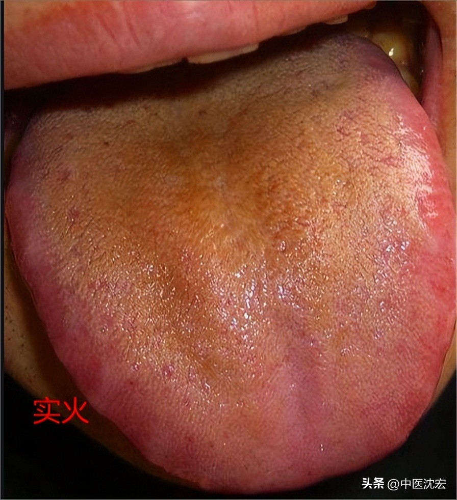 舌头偏红也有舌苔怎么调理,舌红舌胖有裂纹