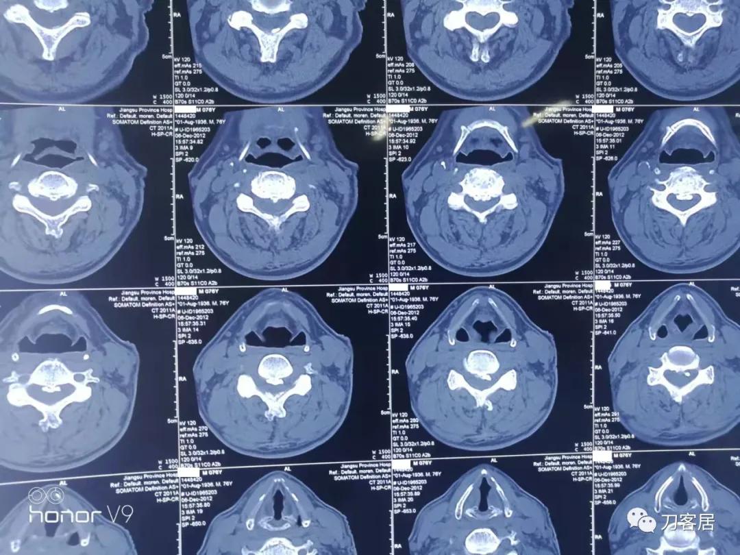 颈椎椎管内肿瘤手术20例麻醉处理,颈椎脊髓内肿瘤手术成功案例