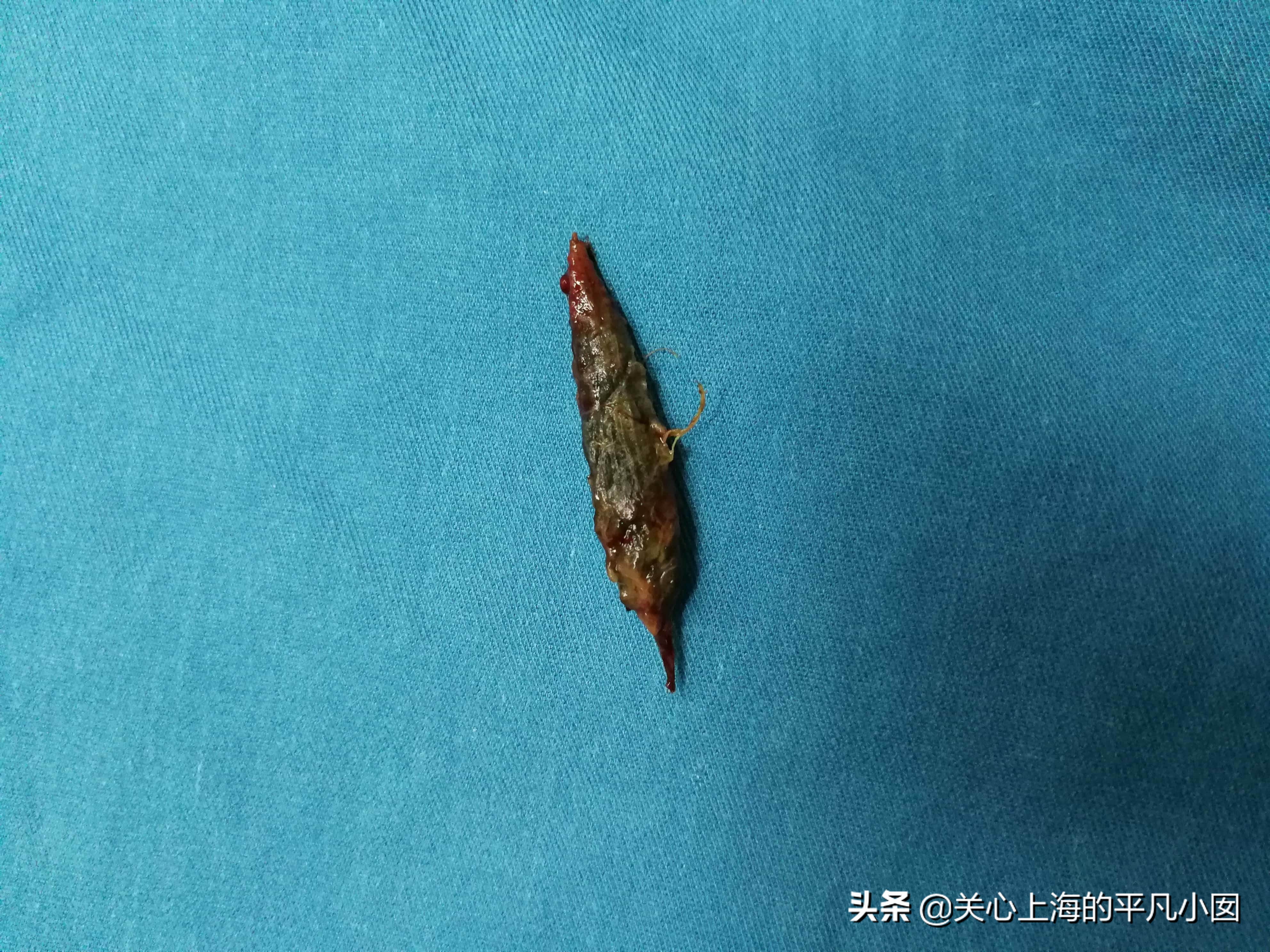 痔疮肛门痛用什么药,肛门瘙痒痛是痔疮吗