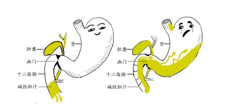 为什么胆有结石必须摘了,胆结石医生为什么都建议割胆