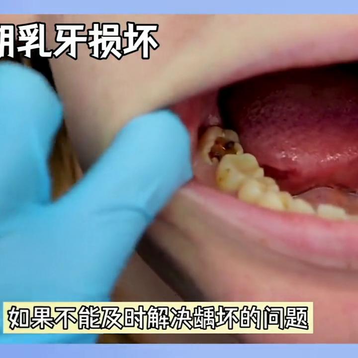 宝宝换牙期牙齿松动了怎么办,宝宝刚出乳牙就龋齿怎么办