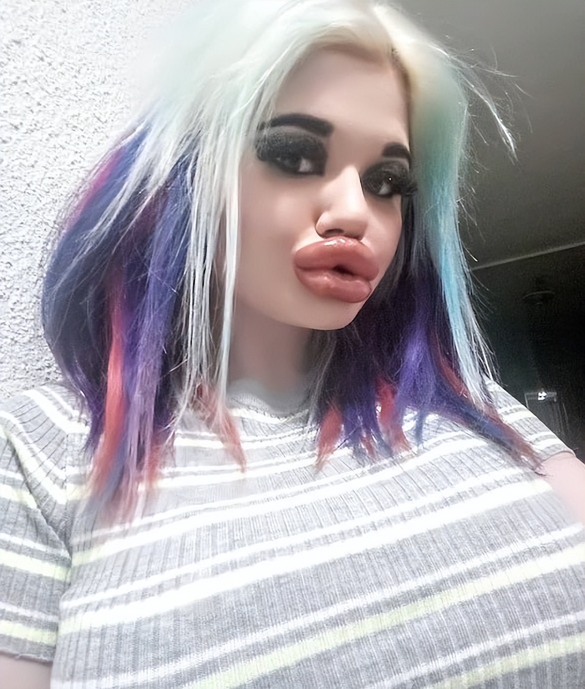 女子狂打30支玻尿酸,丰唇针建议打吗