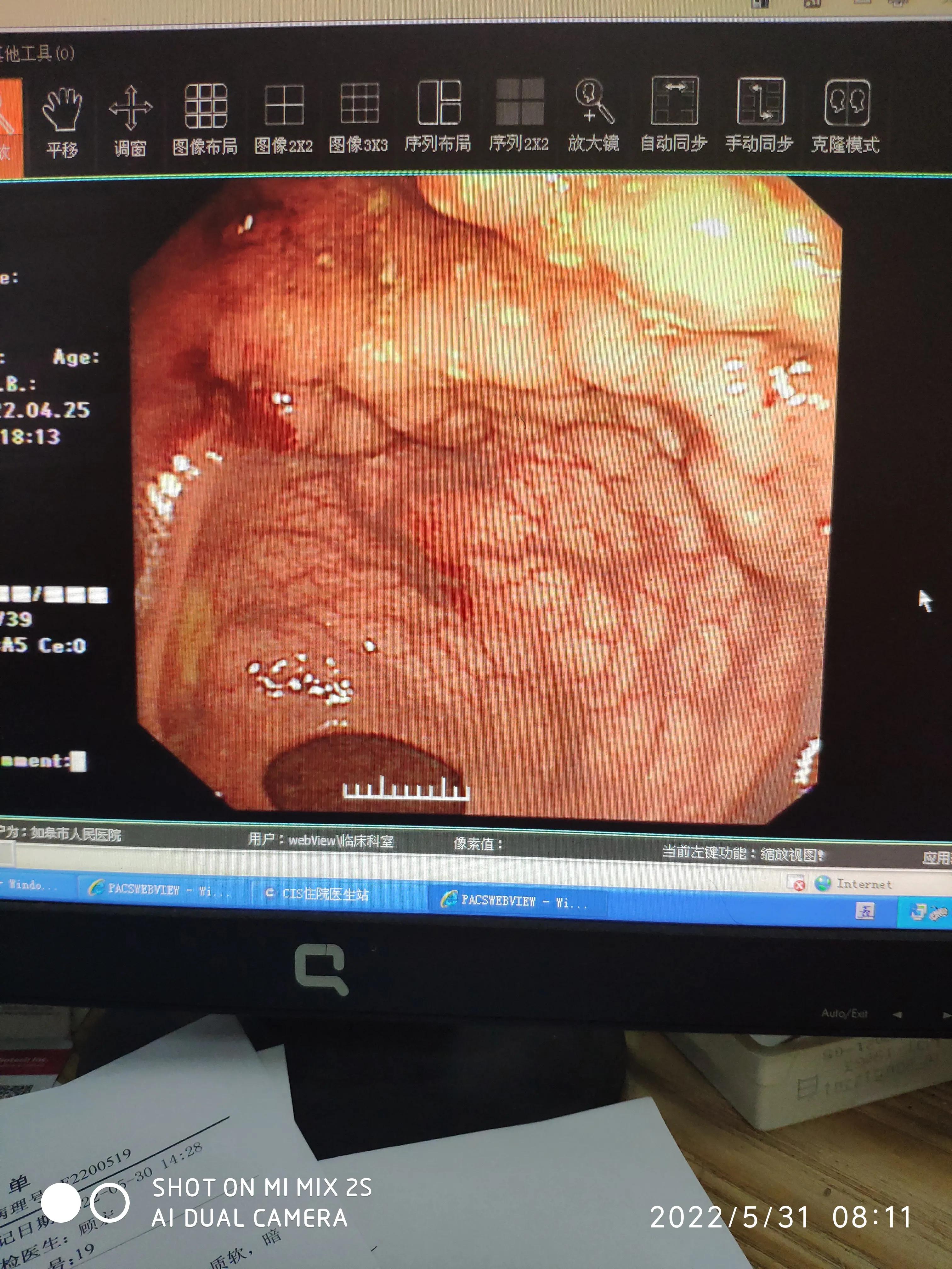 esd手术后续身体感觉,esd手术可靠吗