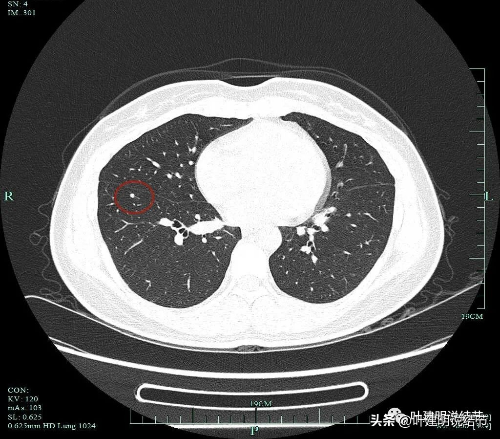 磨玻璃结节伴有增生是癌症吗,磨玻璃结节会是别的癌转移的吗