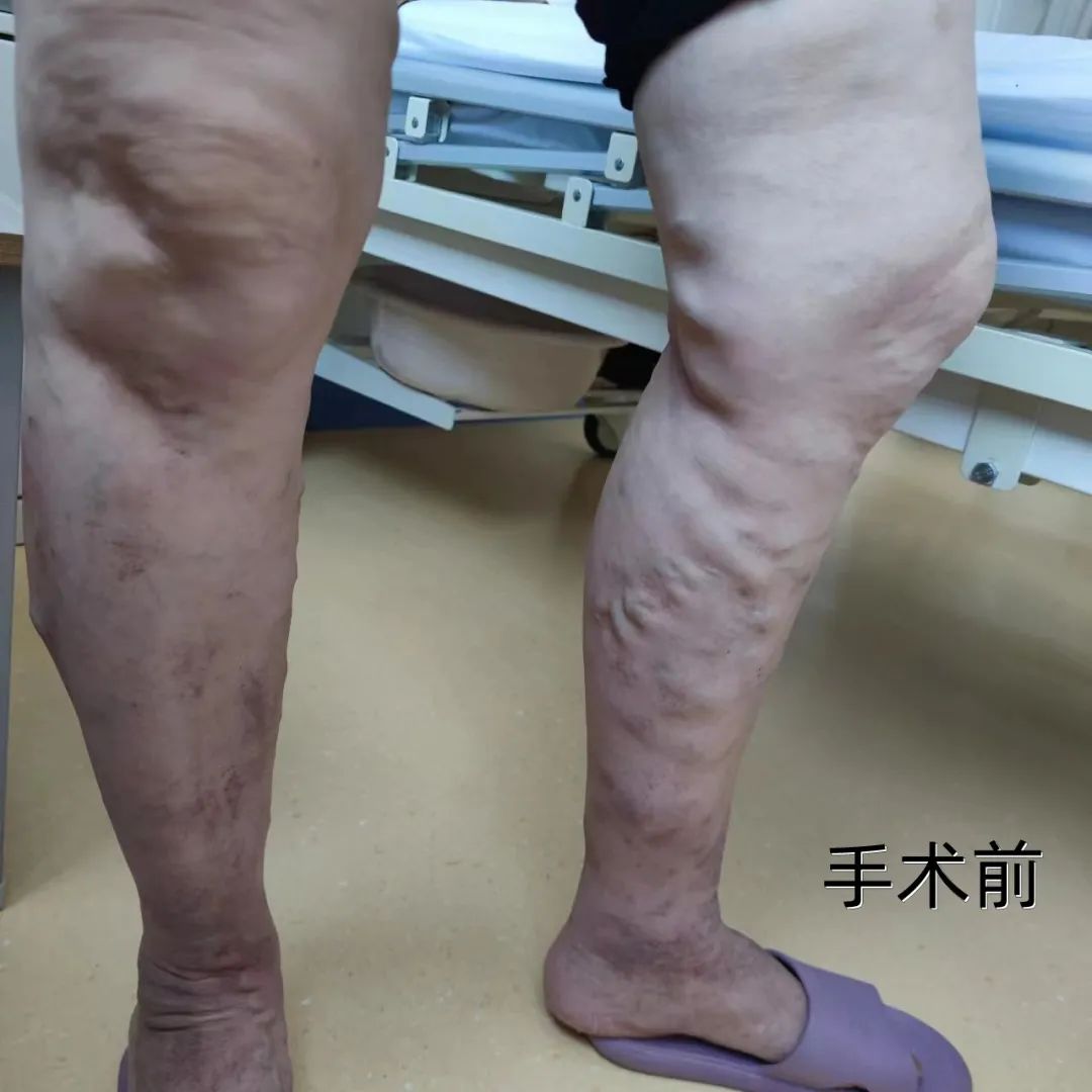 微创无疤！沣东院区完成首例腔内注射硬化剂微创治疗大隐静脉曲张