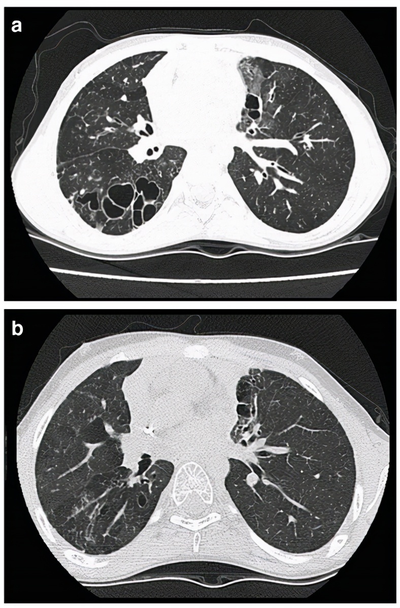 免疫缺陷病会并发什么病,什么是免疫缺陷肺部感染