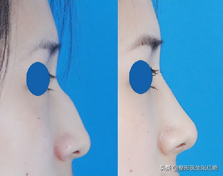 驼峰鼻的矫正八大处,河南驼峰鼻矫正大约费用是多少