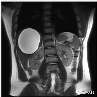 肝包虫病B超能检查出来吗?