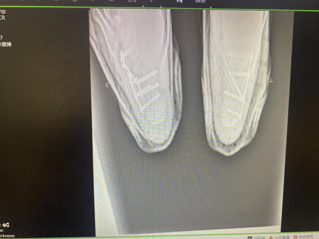 跗骨窦手术能治好吗,跗骨窦入路治疗跟骨骨折适应症